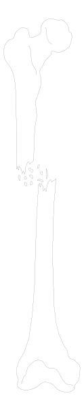 The image shows a black and white photo of an x-ray with two bones crossed over each other on top of what appears to be a gray background.