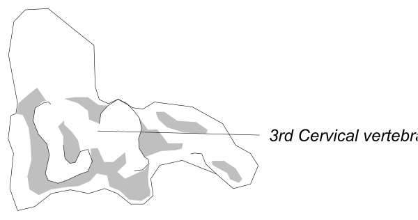The image shows a black and white illustration of an MRI scan with labeled areas indicating different parts of the brain such as "3rd cerebral vein" in red text on top right corner.