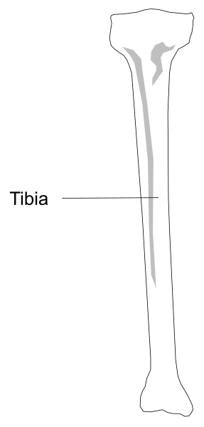 The image shows a black and white illustration of an X-ray with bones labeled "tibia" on it against a gray background.