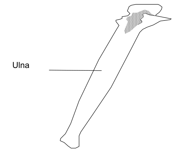 The image shows a black and white illustration of an ulna bone labeled "Ulna" with arrows pointing to it from two different directions indicating its position in relation to other bones within the human arm skeleton structure, set against a plain background without any additional context or details about setting or action.