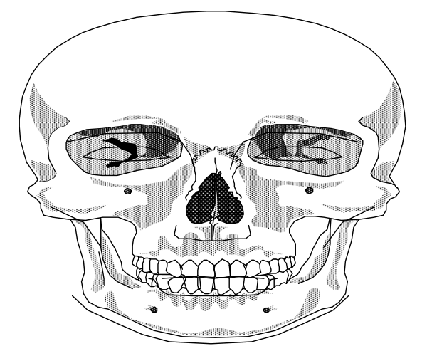 The black and white illustration shows a skull with two eye sockets on either side of its face.