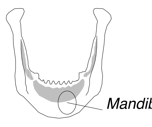 The image shows a black and white illustration of an upper denture with teeth visible on both sides against a light background.