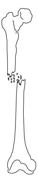 The image shows a black and white illustration of two bones with joints against a gray background.