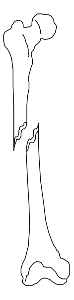The picture shows a black and white x-ray of an arm with bones labeled as "humerus" on it against a gray background.