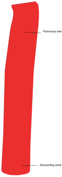 The image shows a red line with text indicating "pneumonia" on it against an otherwise grey background.