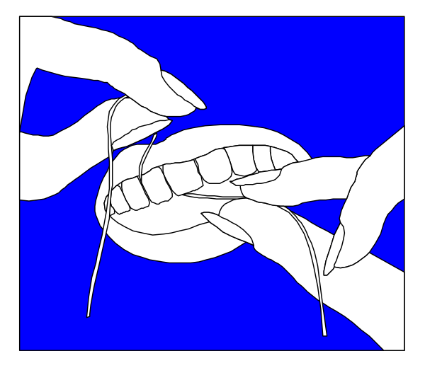 The image shows a cartoon of two hands holding up an open mouth with teeth inside it to reveal dental floss being used on them; there is no text present in this clip-art illustration.