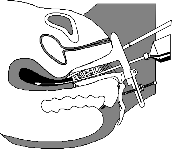 The black and white illustration shows a closeup of an open mouth with teeth visible inside it, accompanied by medical instruments such as forceps in front of the lower lip area suggesting dental surgery is being performed on this model head.