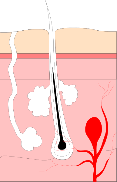 The image shows a closeup of skin with various medical tools such as scalpels around it, indicating some sort of surgical procedure is being performed on an area that appears to be affected by acne or psoriasis due to redness and inflammation in one section.